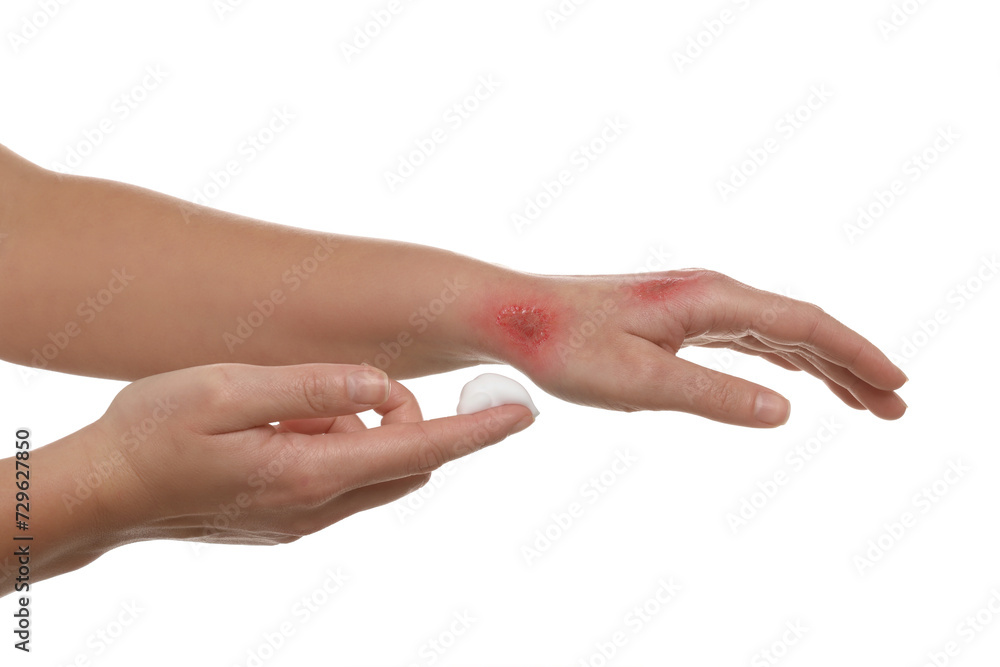 Woman applying panthenol onto burned hand on white background, closeup