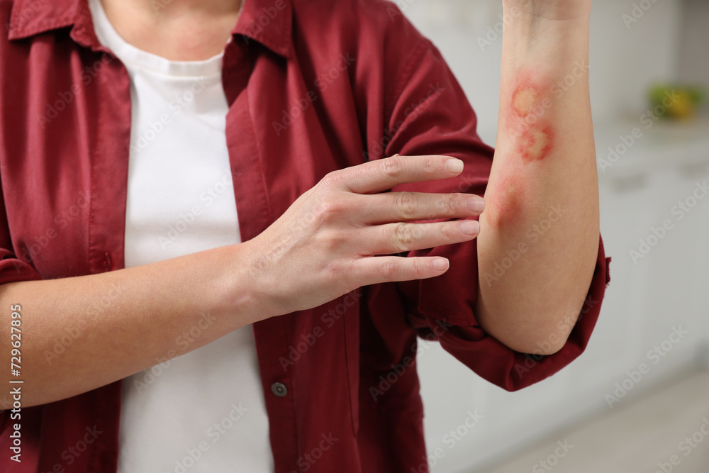 Woman with burns on her hand in kitchen, closeup
