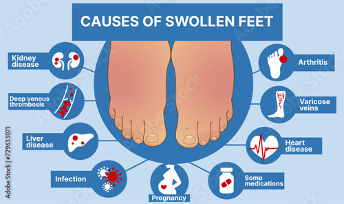 Causes of swollen feet. Healthcare infographic, educational illustration. Vector illustration.  photo