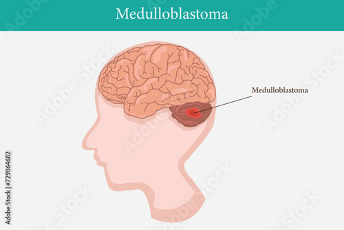 Human anatomy disease. medulloblastoma vector illustration on white background. eps 10
