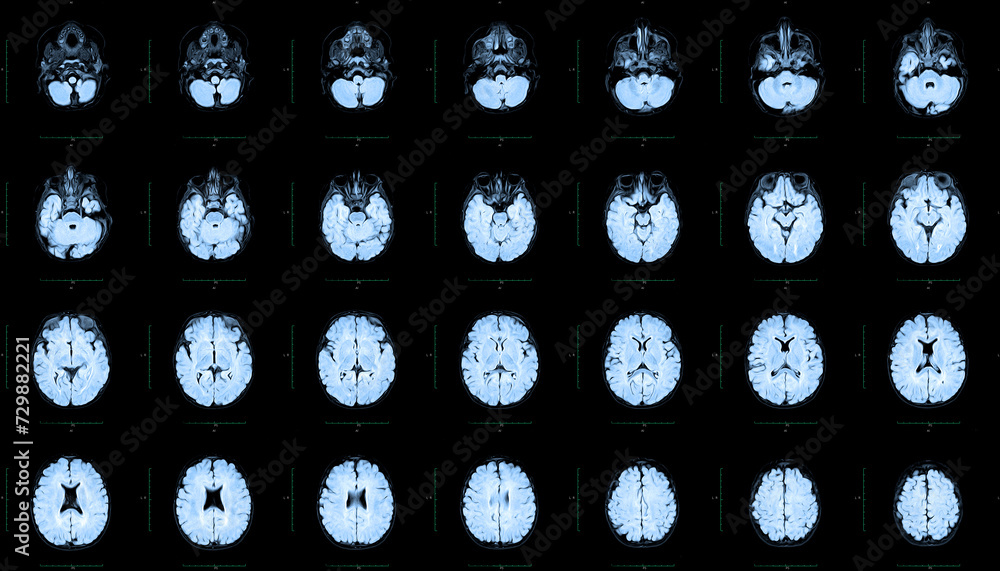 MRI of the skull and brain of a person with cerebral malformations ...