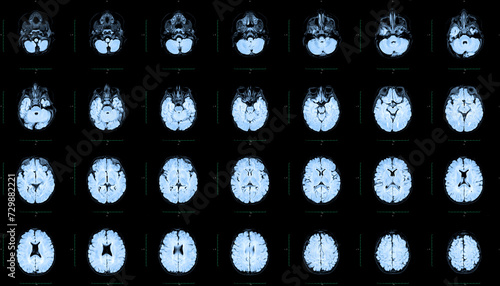 Tableau sur toile MRI of the skull and brain of a person with cerebral malformations, preliminary diagnosis, holoproencephaly, absence, agenesis of the transparent septum, one-year-old boy, top view