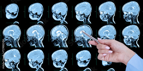 Obraz na płótnie Doctor's hand points to a set of MRI scans of the human skull and brain, with cerebral malformations, preliminary diagnosis, holoproencephaly, absence, agenesis of the transparent septum, side view