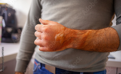 A man's hand burned with boiling water. On it there are redness and blisters.
