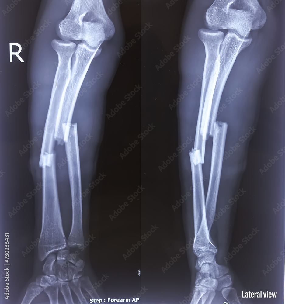 Plaster cast obscured the bony details. X-ray image of broken forearm, AP and lateral view show fracture of ulna and radius bone. Plaster cast obscured the bony details. X-ray image of broken forearm, AP and lateral view show fracture of ulna and radius bone.