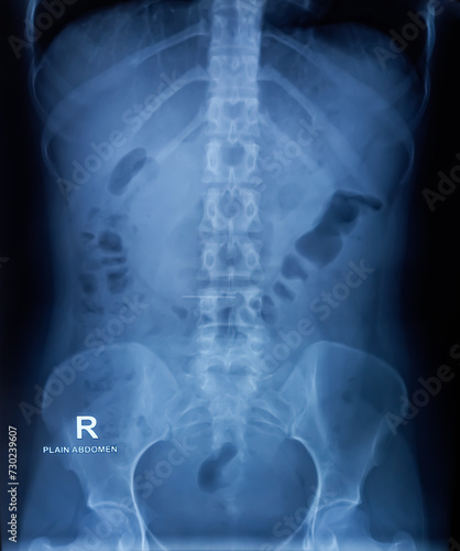Plain X-ray of Abdomen in erect posture. Large bowel loops are distended with gas and loaded faecal matters. Linear radio opaque shadow suggest matallic foreign body at abdomenal region. photo