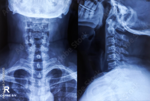 X-ray of Cervical spine AP and Lateral view. Early degenerative change at cervical spine. Minimal marginal osteophytes are noted in the cervical vertebrae. photo