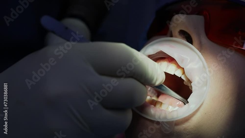 Dentist uses pincers for inserts tampon in patient mouth with lips holder. Slow motion photo
