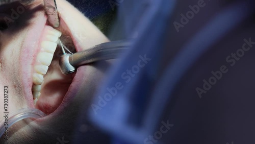 Dentist bores tooth of patient with spatter from spray of drilling machine photo