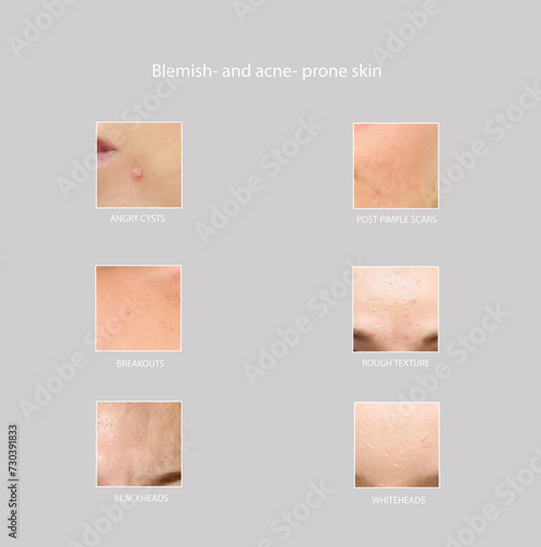 Types of Acne