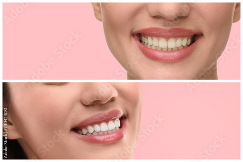 Woman showing teeth before and after whitening on pink background, collage