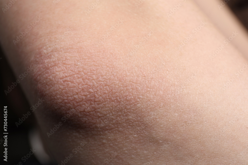 Woman with dry skin on elbow, closeup Woman with dry skin on elbow, closeup
