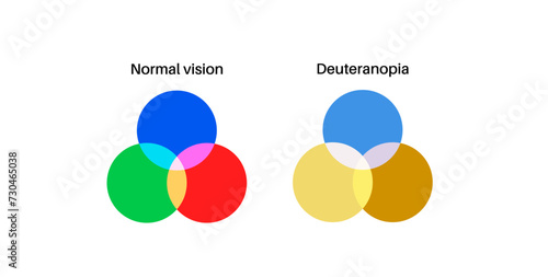 Deuteranomaly and deuteranopia