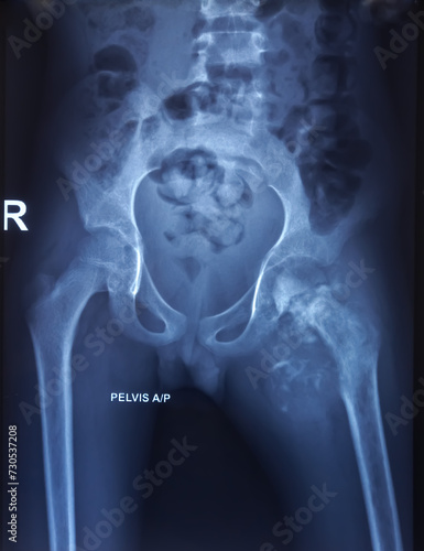 X-ray of pelvis. Chronic osteomyelitis involving proximal shaft and neck of the femur. Defused sclerosis. photo