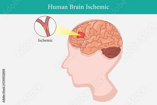 Human anatomy disease ischemic stroke vector illustration on white background. eps 10