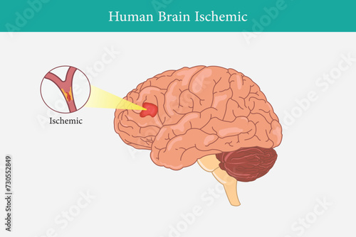 Human anatomy disease ischemic stroke vector illustration on white background. brain problem eps 10