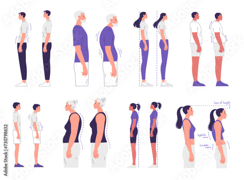 People with correct and incorrect posture. Scoliosis, curvature of the spine