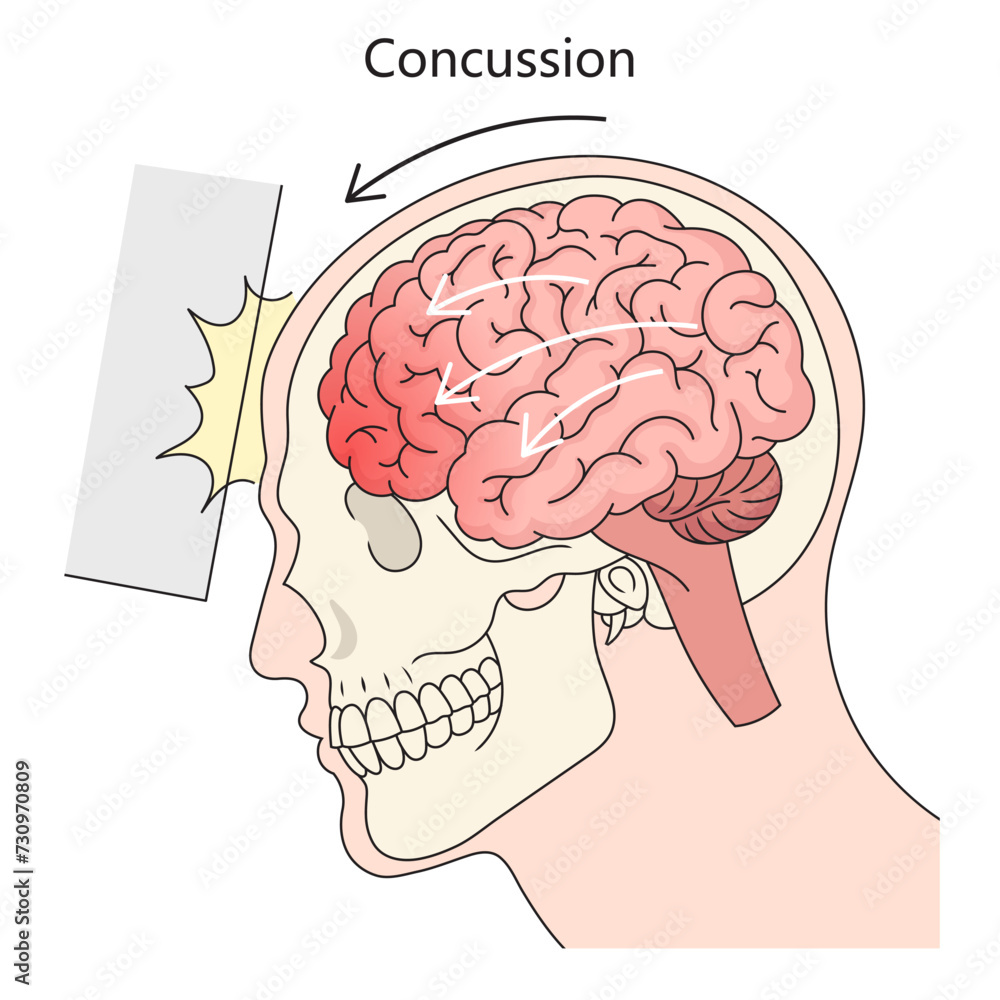 Human brain concussion structure diagram hand drawn schematic vector illustration. Medical science educational illustration Human brain concussion structure diagram hand drawn schematic vector illustration. Medical science educational illustration