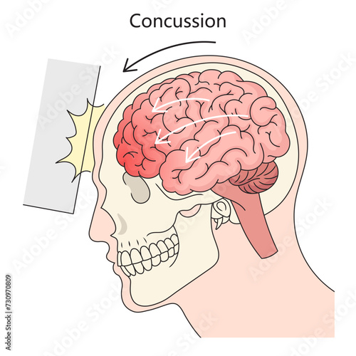 Human brain concussion structure diagram hand drawn schematic vector illustration. Medical science educational illustration
