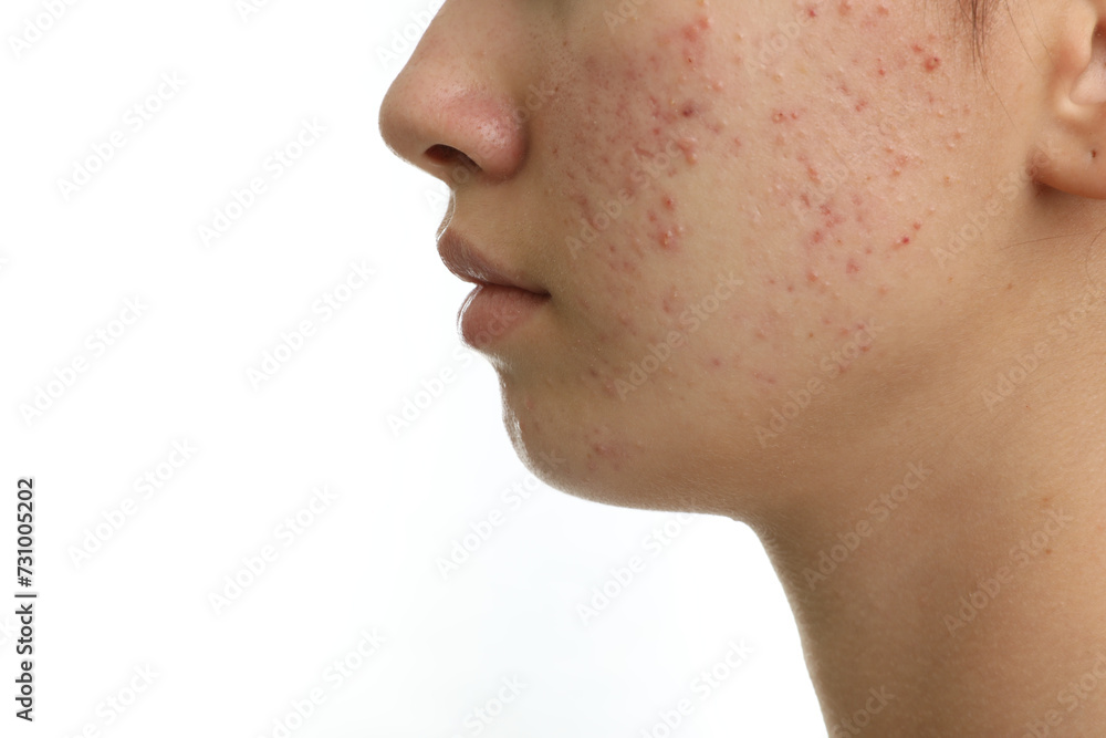 Teenage girl with acne problem on white background, closeup Teenage girl with acne problem on white background, closeup