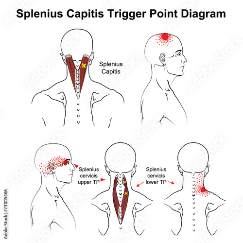 Splenius Capitis Trigger Point vector Diagram