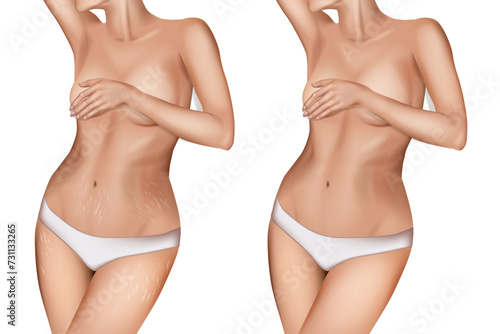 Stretch marks, also known as striae or striae distensae. Striae are caused by tearing of the dermis. Before and After 
