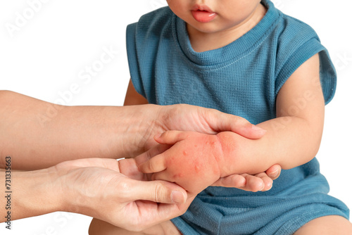 Asian baby have red swollen and blister on hand caused by insect bite, on white background.