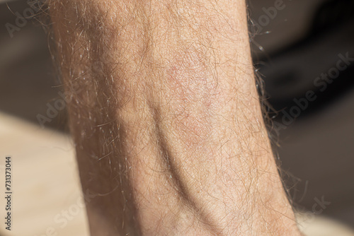 Large plaque parapsoriasis on caucasian man legs photo