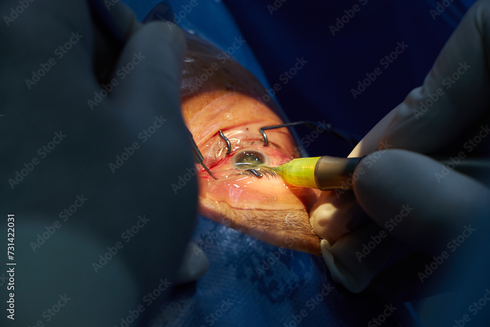 Phacoemulsification, destruction of the opaque lens by ultrasound, ophthalmic eye surgery. eye lens replacement, intraocular lens installation, surgical cataract treatment. 