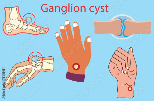 Ganglion cyst,soft, gel like masses,smooth and round,welling in the hand, wrist and foot,Medical vector illustration of ganglion foot cyst with bones. Big ganglion cysts,a sac of jelly fluid,vectors