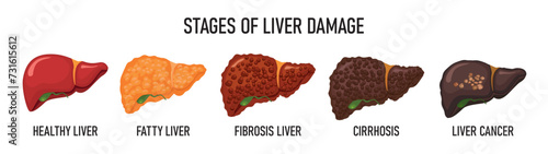 Stages of liver destruction