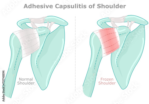 Adhesive capsulitis or frozen shoulder. Capsule and bone broken arm. Shoulder joint becomes inflamed and stiff over. Medical illustration. Vector photo