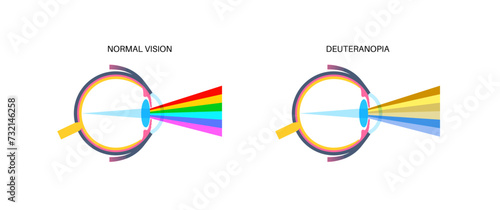 Deuteranomaly and deuteranopia photo