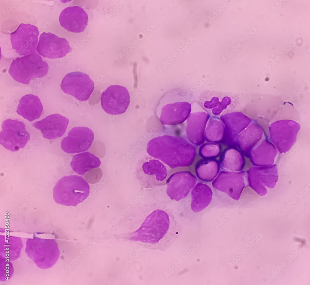 Acute myeloid leukemia (AML). Smear show shift maturation of then are