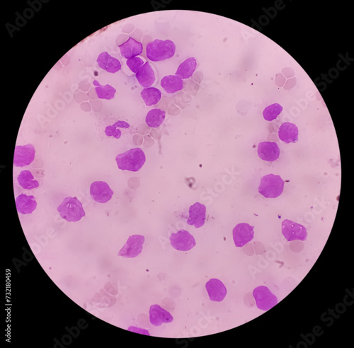 Acute myeloid leukemia (AML). Smear show shift maturation of then are blast cells, low N : C ratio, abundant cytoplasm, loose chromatin and prominent nucleoli. Thrombocytopenia. photo