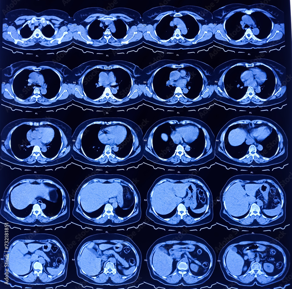 Multi Slice HRCT Scan Of Chest Prominent Broncho Vascular Markings In loss-of-lung-markings-chest-x-ray-medschool
