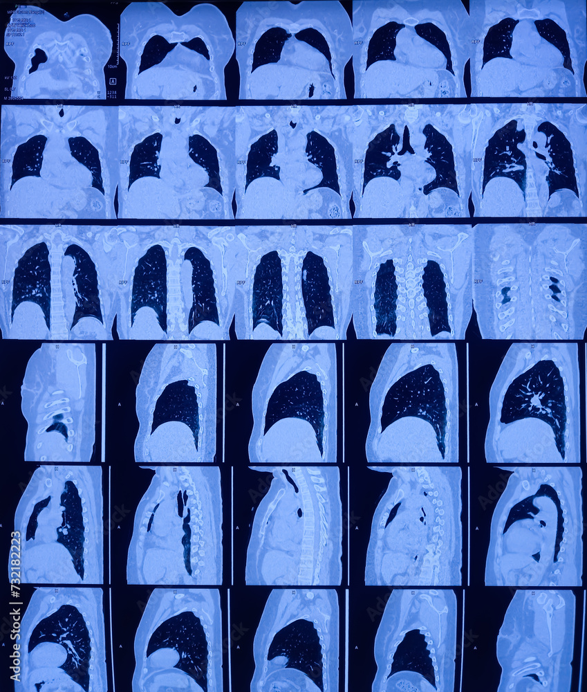 Multi Slice HRCT Scan Of Chest Prominent Broncho Vascular Markings In multi-slice-hrct-scan-of-chest-prominent-broncho-vascular-markings-in