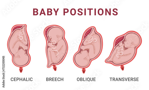 Baby positions in uterus during pregnancy medical anatomy gynecology scheme vector flat
