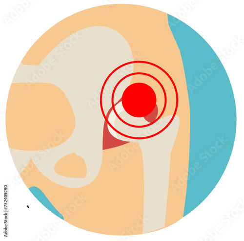 Hip Osteoarthritis icon. Flat style. Front view of hip joint with section of the pelvis. Lower back and joint pain. Medical, healthcare, elderly diseases graphic concept