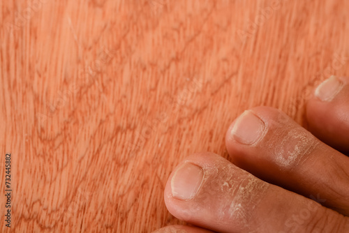 Athlete's foot, medically known as tinea pedis, fungal infection affecting the skin of the feet with symptoms such as itching, burning, and redness. photo