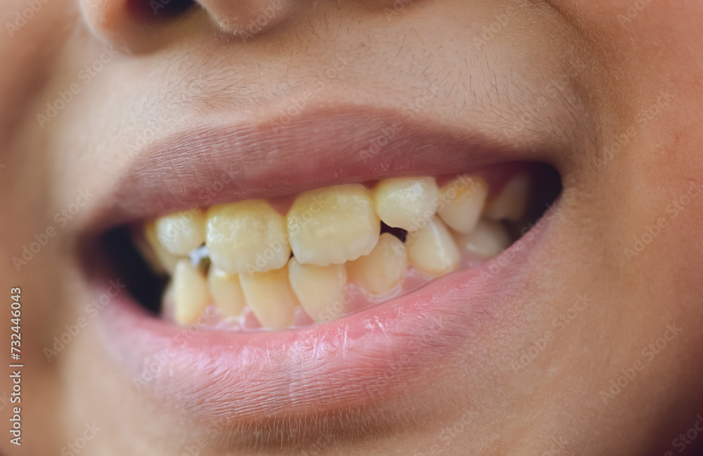 Fototapeta premium a child displaying his yellowed teeth, highlighting the importance of dental health care and hygiene practices in dentistry.