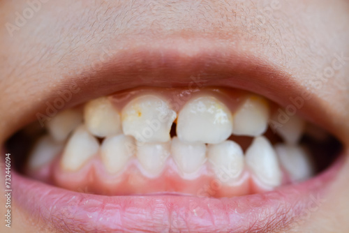 A zoomed-in image captures the mouths of children with misaligned, fractured teeth and odontolith.
