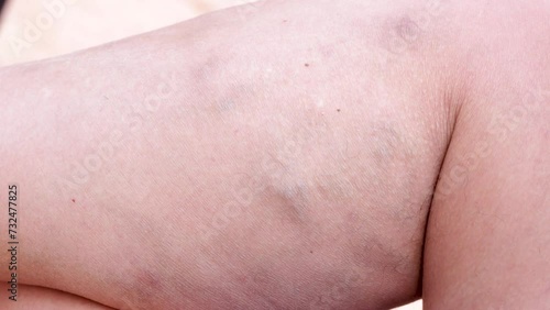 varicose veins, deep vein thrombosis, venous injuries on legs