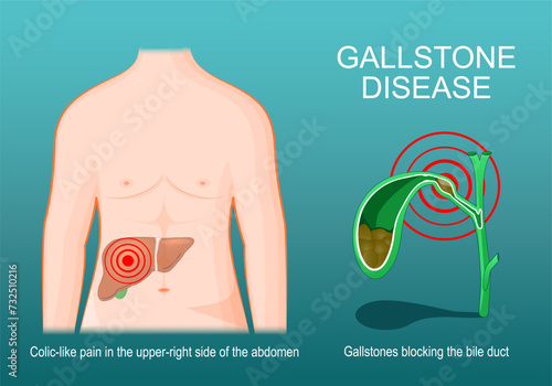 Cross section of Gallbladder with Gallstones photo