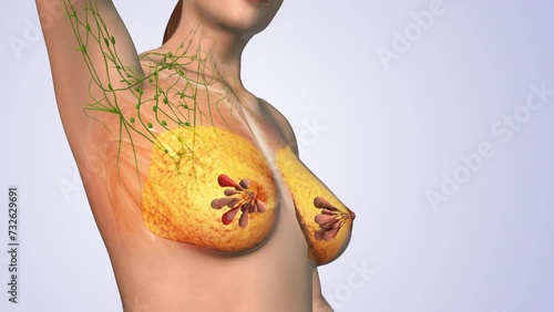 Medical animation for breast carcinoma