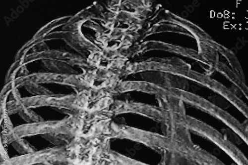 Chest CAT- SCAN of rib fracture. Medical themes