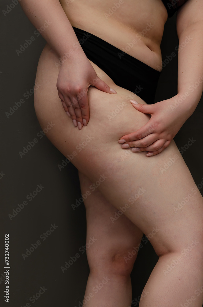 Fototapeta premium Cellulite. Stretch marks on the body. A young girl with cellulite. 