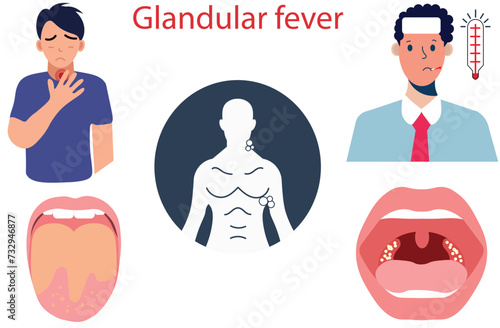 Glandular fever,high temperature (fever),sore throat , swollen glands in neck and under armpits,A swollen tongue with white coating,scarlet fever,lymphoma,Lip Syphilis bacteria virus,five vectors photo