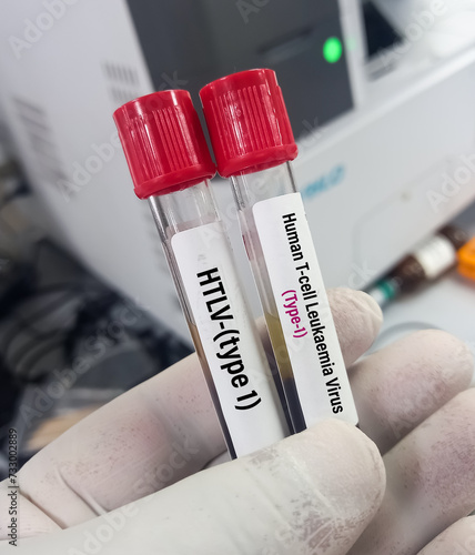 Blood sample for Human T-lymphotropic virus or Human T-cell leukaemia virus or HLTV type 1 test, to diagnose a type of cancer called adult T-cell leukaemia or Lymphoma. photo