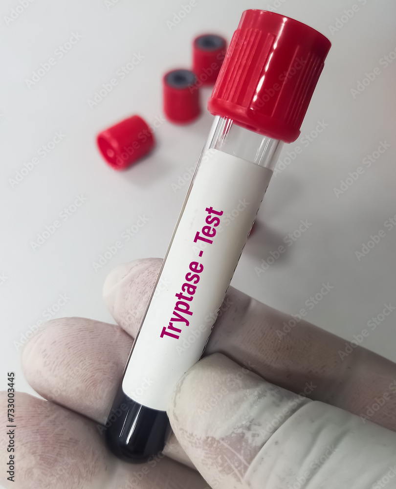Blood sample for Total Tryptase test. A tryptase test can help doctors